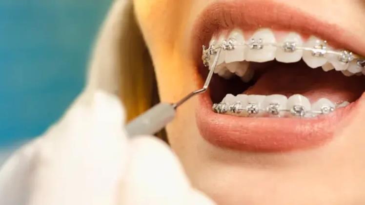 The Ultimate Guide to Dental Braces in Ontario: What You Need to Know